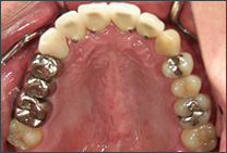 セラミックによる白い歯(上部構造物)を載せて治療の終了
