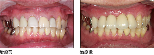 食事も気を使うほどグラついた前歯4本を無痛インプラントにて治療