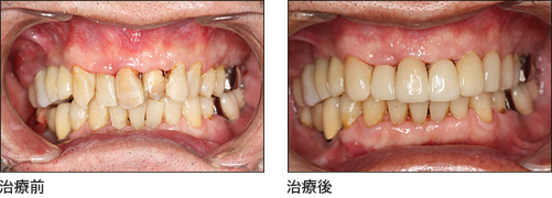 インプラントと同時に独自エクステンションで前歯も美しく治療
