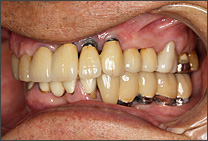 セラミックによる白い歯(上部構造物)を載せて治療の終了