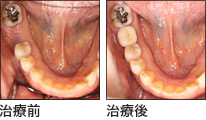 東海林歯科の「無痛インプラント」治療を知りご来院