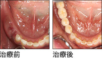 無痛インプラントで噛み合わせを含めたトータル治療