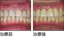 食事も気を使うほどグラついた前歯4本を無痛インプラントにて治療