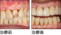 インプラントと同時にエクステンションで前歯も美しく治療