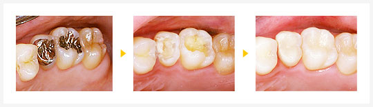 削らない虫歯治療の症例