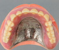 強度があり、違和感が少ない金属床義歯