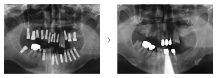 パノラマレントゲンでのインプラント治療前・治療後
