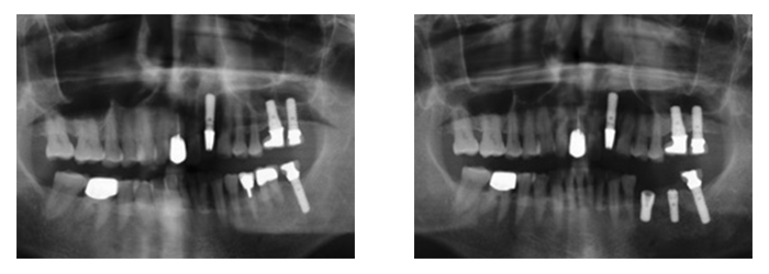 パノラマレントゲンでのインプラント治療前・治療後