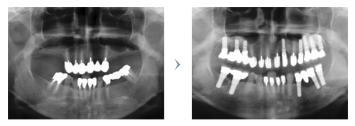 パノラマレントゲンでのインプラント治療前・治療後