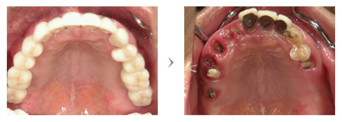 インプラント治療前・治療後