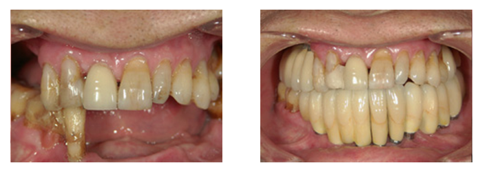インプラント治療前・治療後