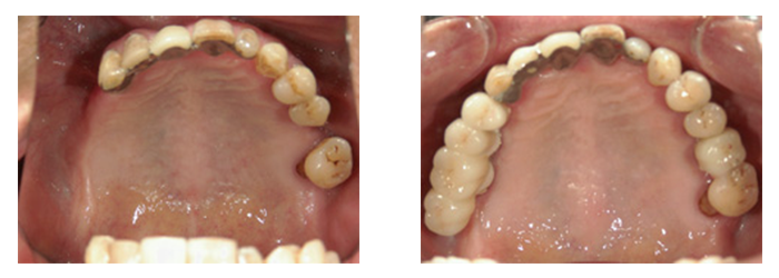 インプラント治療前・治療後