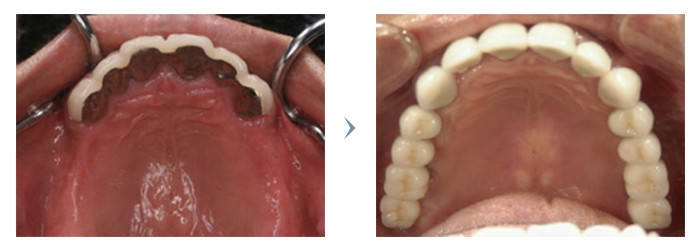 インプラント治療前・治療後