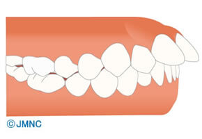 上顎前突