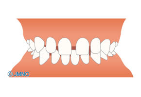 空隙歯列