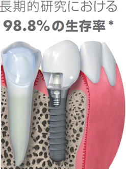 ストローマンインプラントの高い生存率と安全性について