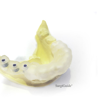 より安心できる安全なインプラント治療のために、東海林歯科は常に努力を続けています。