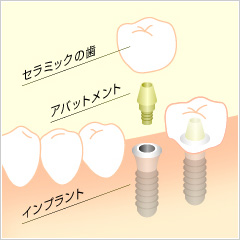 インプラントの機能性と信頼性