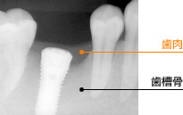 歯槽骨（しそうこつ）とは？