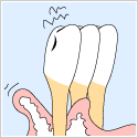 重い歯周病の方