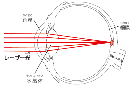 レーザー治療でどうしてメガネをするの？