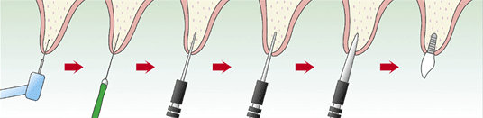 OAM式インプラント埋入法 / ピエゾサージェリー