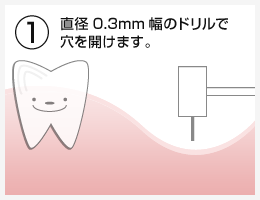 OAM式インプラント埋入法治療の流れ