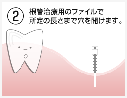 OAM式インプラント埋入法治療の流れ