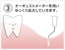 OAM式インプラント埋入法治療の流れ