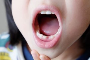 子供の歯になぜデンタルフロスが必要なの？
