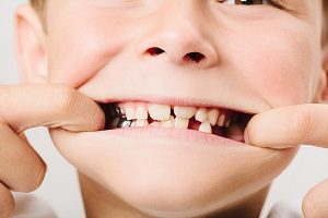 子供の歯列矯正