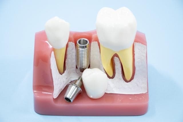 インプラントが緩んで外れた様子