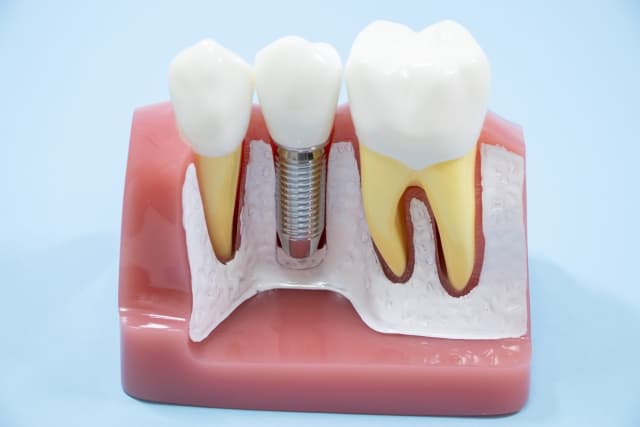 インプラントの模型