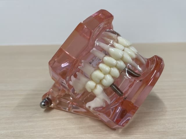 インプラントの模型