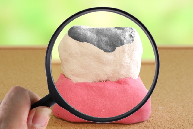 虫歯ができた歯のイメージ
